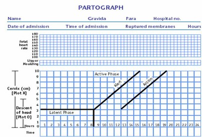 Partogram in Obstetrics Complete Guide for Monitoring Labour Progress