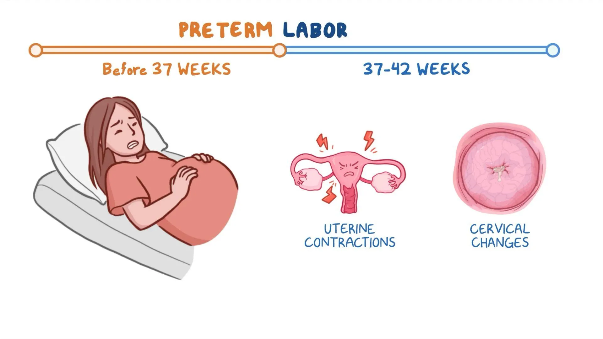 Preterm Labor: Causes, Diagnosis, Prevention and Management
